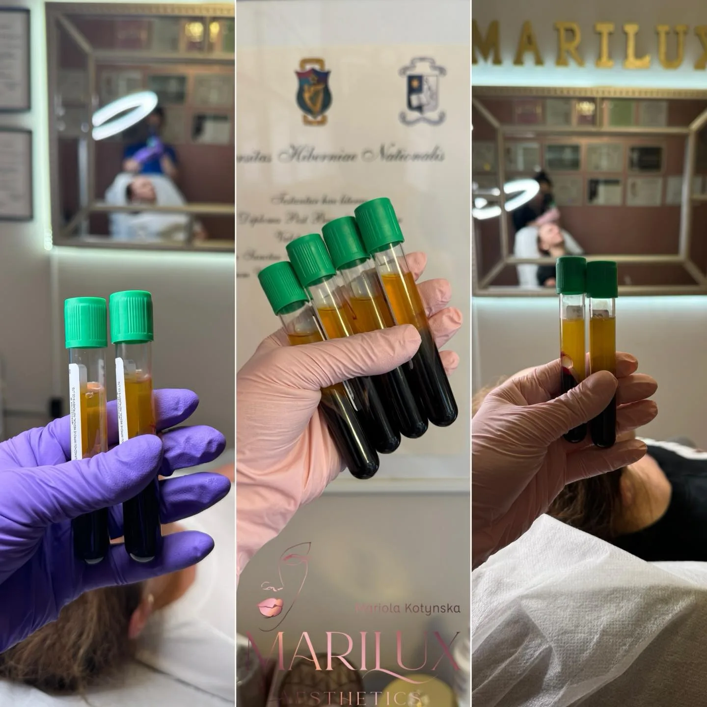 PRP therapy — platelet rich plasma vials showing different treatment stages